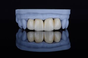 cimentação de facetas dentárias